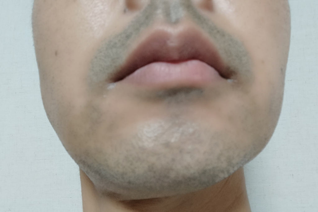 ヒゲ脱毛1回目前の施術前写真。青みが強く毛量が多い状態で、レーザーを当てる前の実際の濃さがわかる。