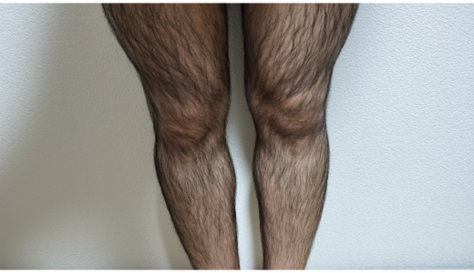 全身脱毛前の脚の体毛の状態（毛量が多いケースの例）