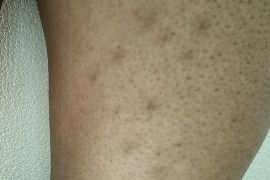 照射後約2ヶ月の太ももの毛嚢炎(跡がやや薄くなってきた状態)