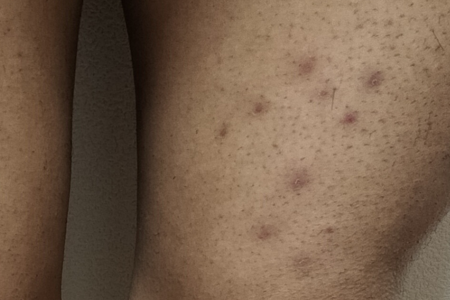 照射後約3週間の太ももの毛嚢炎（治りかけで跡が残っている状態）