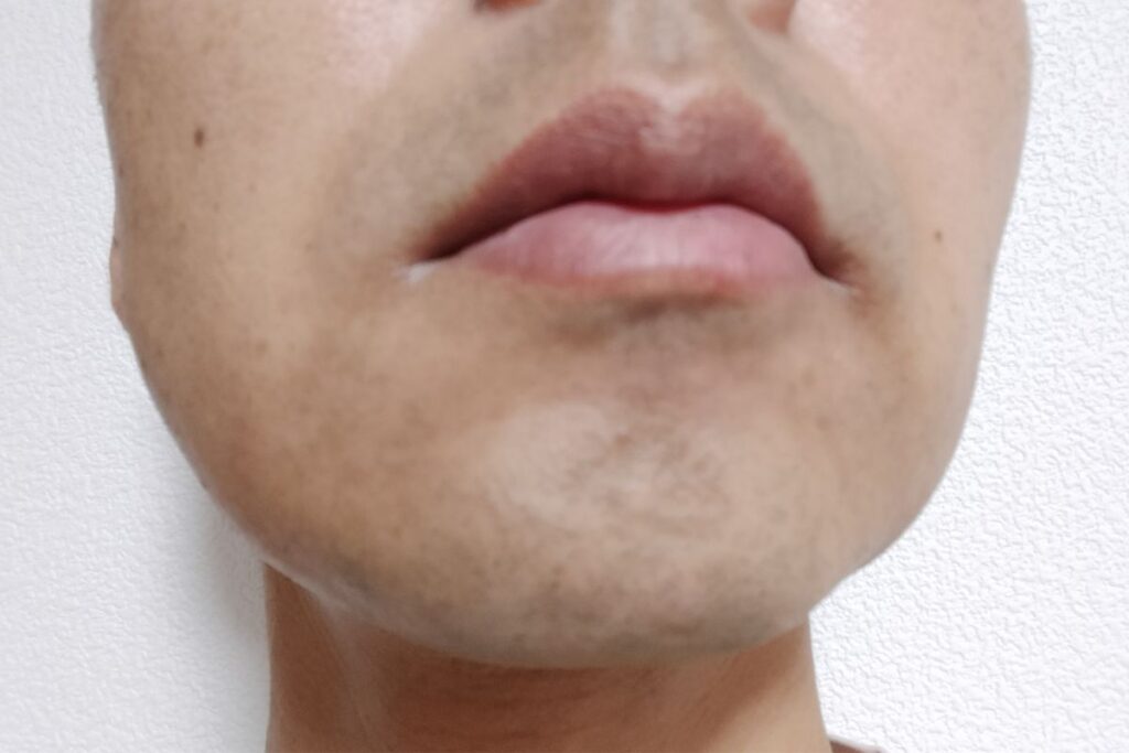 ヒゲ脱毛1回目の照射から約18日後、ポロ期で毛が抜け落ち始めた状態の写真