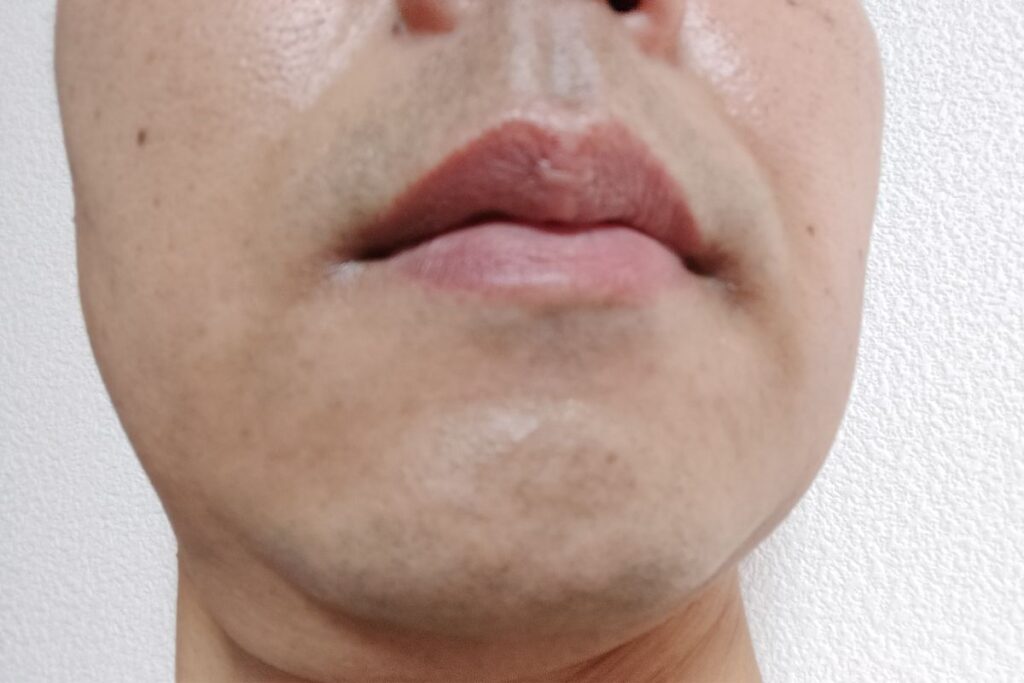 医療脱毛ヒゲ1回目照射から7週後の生え戻り状態（2回目前）