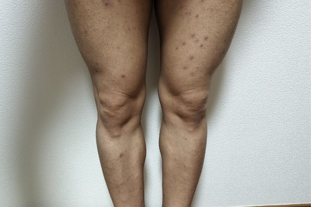 全身脱毛1回目の照射から約24日後、脚の毛がポロ期で少しずつ抜け始めた様子