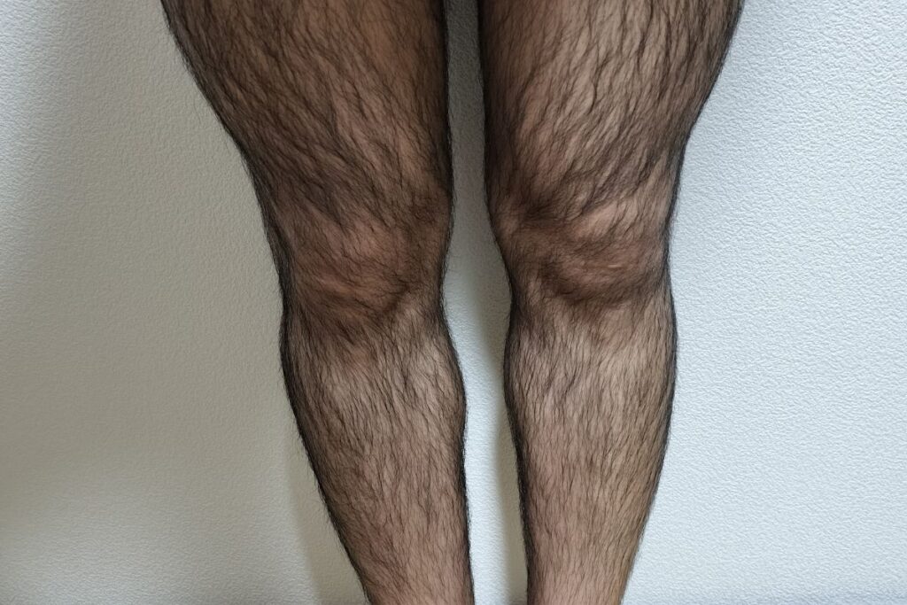 全身脱毛1回目前の脚の状態。 毛量が多いケースの一例。