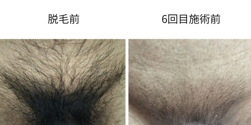 VIO脱毛前と6回目施術前のVラインの毛量比較