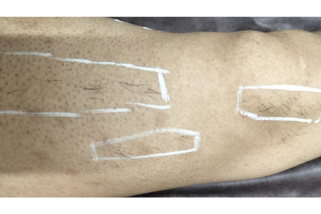 医療脱毛 照射漏れ マーキング確認