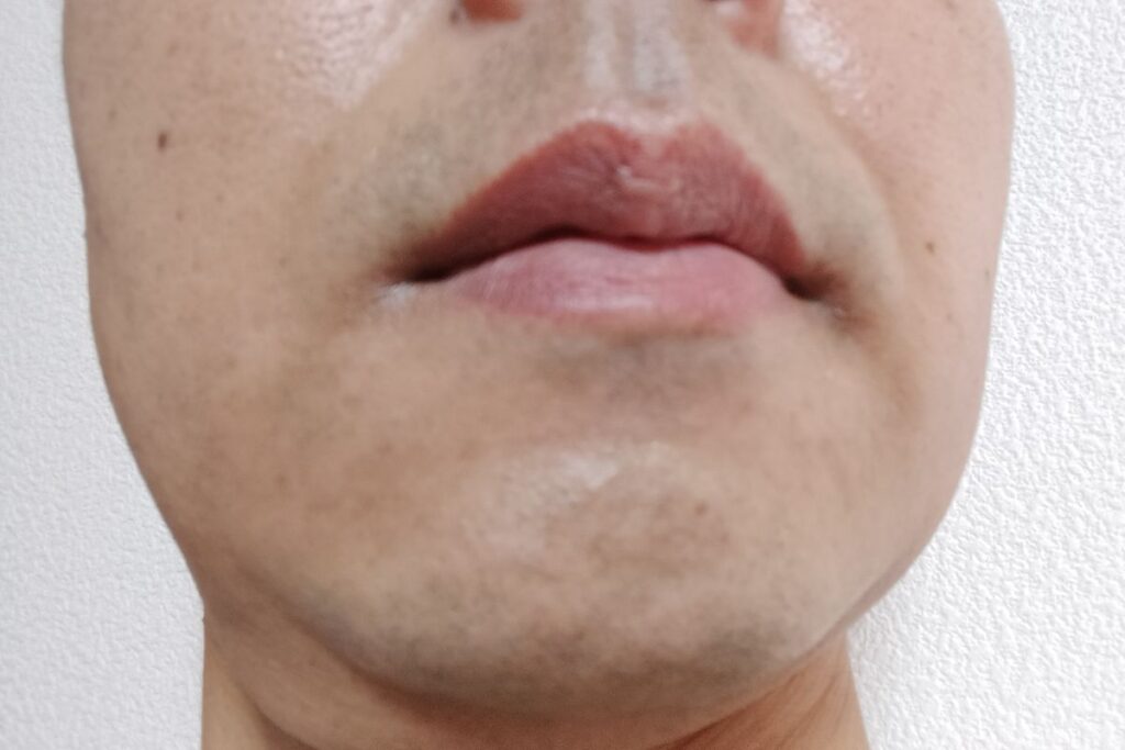 ヒゲ脱毛2回目後の剃毛後の顔。青みは残るがやや減っている状態