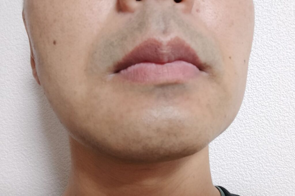 ヒゲ脱毛3回目の剃毛後の状態。青みが部分的に戻ったように見える