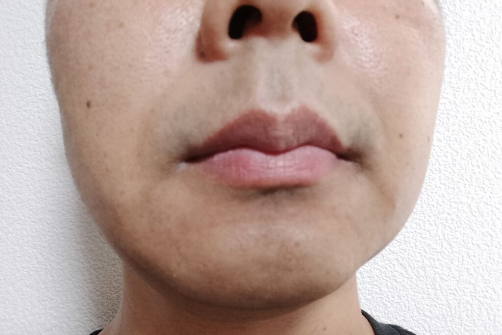ヒゲ脱毛4回目の剃毛後の顔。青みが全体的に薄くなっている状態