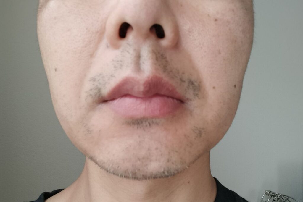 ヒゲ脱毛4回目直前の鼻下とアゴの状態｜部分的に欠けがありまだらに見える様子
