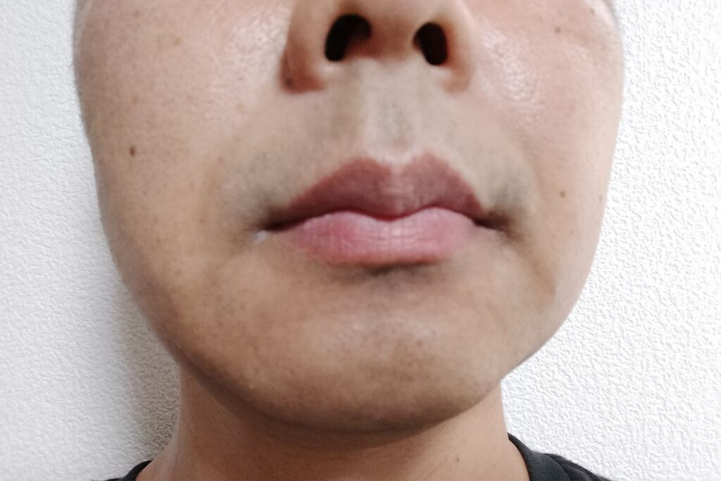 ヒゲ脱毛4回目直前の全体の状態｜密度は減ったが青みがまだ残っている様子