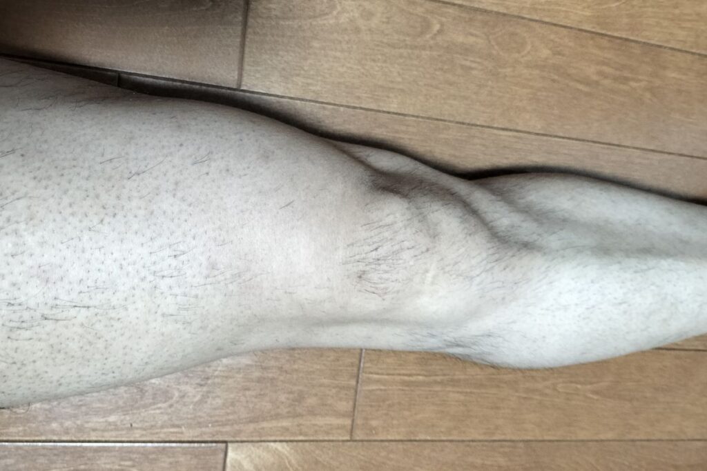 全身脱毛2回目後の脚のアップ。まだらに毛が残る状態