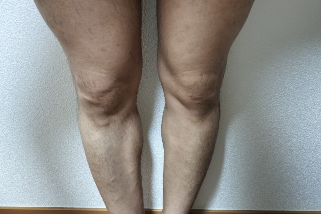 全身脱毛2回目後の両脚全体。毛が減り全体的に薄くなった状態