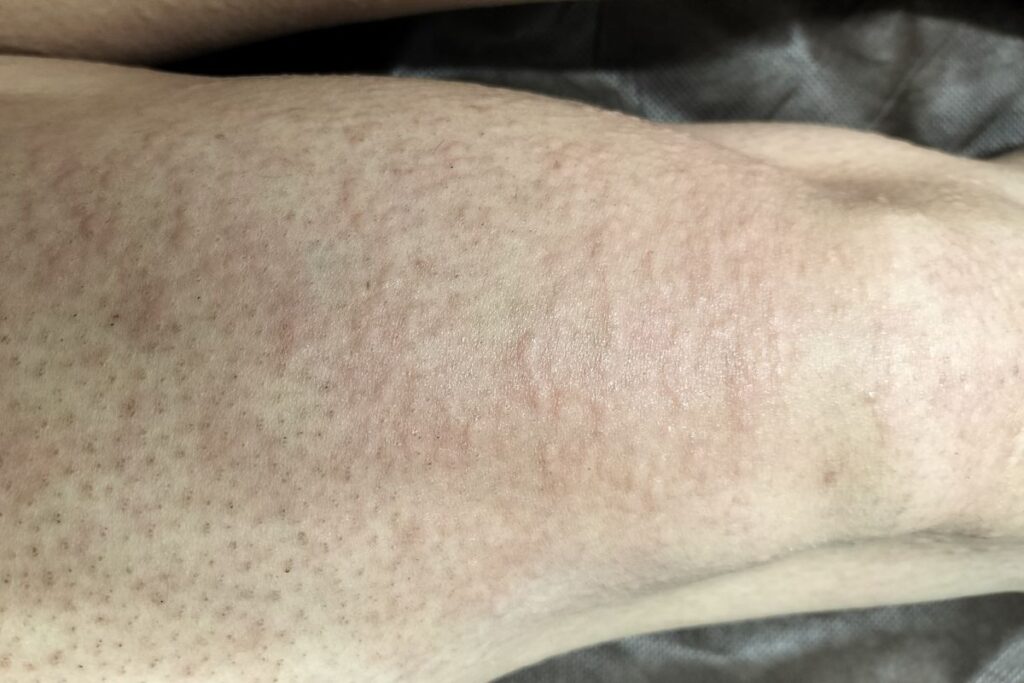 全身脱毛施術直後の肌の反応｜赤みと軽い膨らみが出ている状態