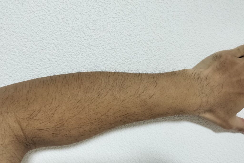 全身脱毛3回目時点の腕の状態｜まだらに毛が残っている様子（40代男性）
