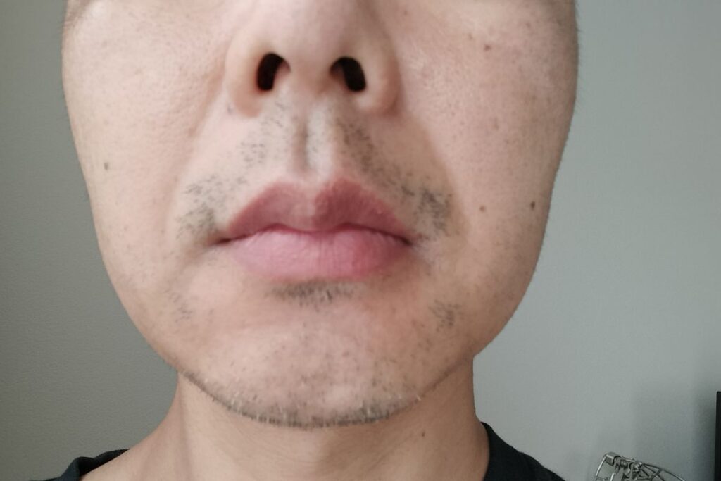 4回目剃毛前： 40代男性のヒゲ脱毛4回目後、少しヒゲを伸ばした状態。黒ヒゲが減り始める一方で、アゴ周りの白髪が目立ち始めた頃の様子