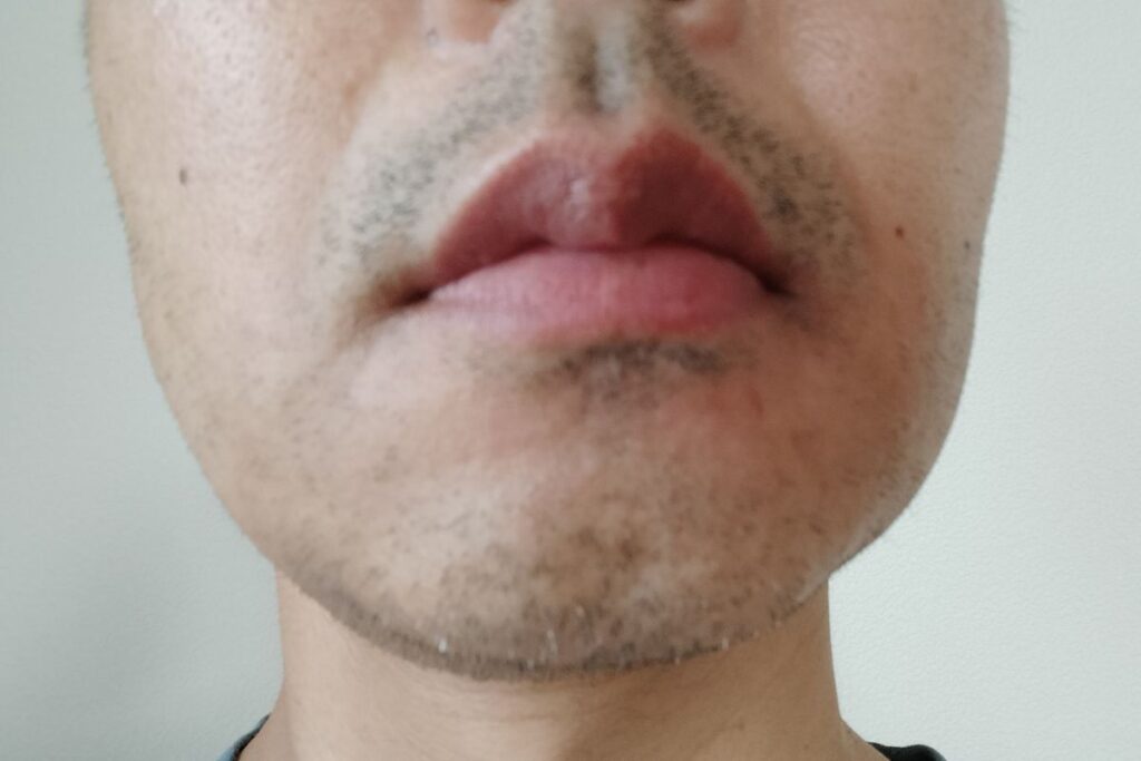 5回目剃毛前： 40代男性のヒゲ脱毛5回目後、数日ヒゲを伸ばした状態。全体の密度は減っているが、鼻下にはまだヒゲが残り、白髪も目立ち始めている