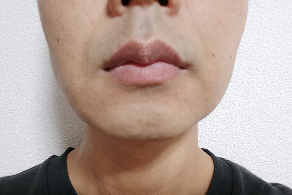 40代男性のヒゲ脱毛5回目後の剃毛直後。鼻下に青みが残る一方、全体の密度はかなり減少している状態