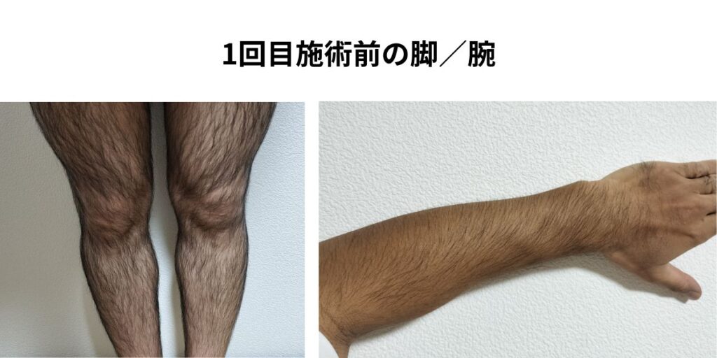 全身脱毛1回目施術前の脚と腕。照射前で毛量が多い40代男性の状態