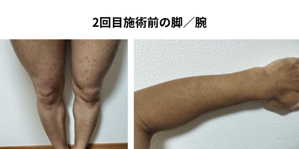 全身脱毛2回目施術前の脚と腕。1回照射後で毛が完全に生えそろう前の状態