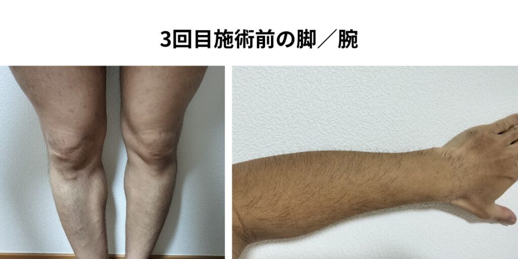 全身脱毛3回目施術前の脚と腕。2回照射後で脚は薄くなり、腕にはまだ毛が残る状態