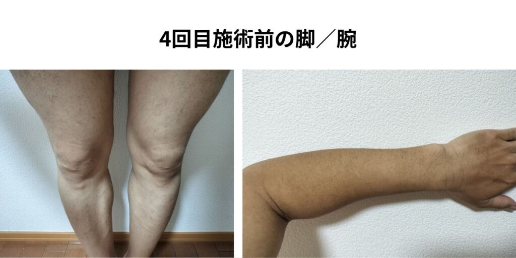 全身脱毛4回目施術前の脚と腕。3回照射後で脚は薄くなったが腕や脚の一部に毛が残る状態