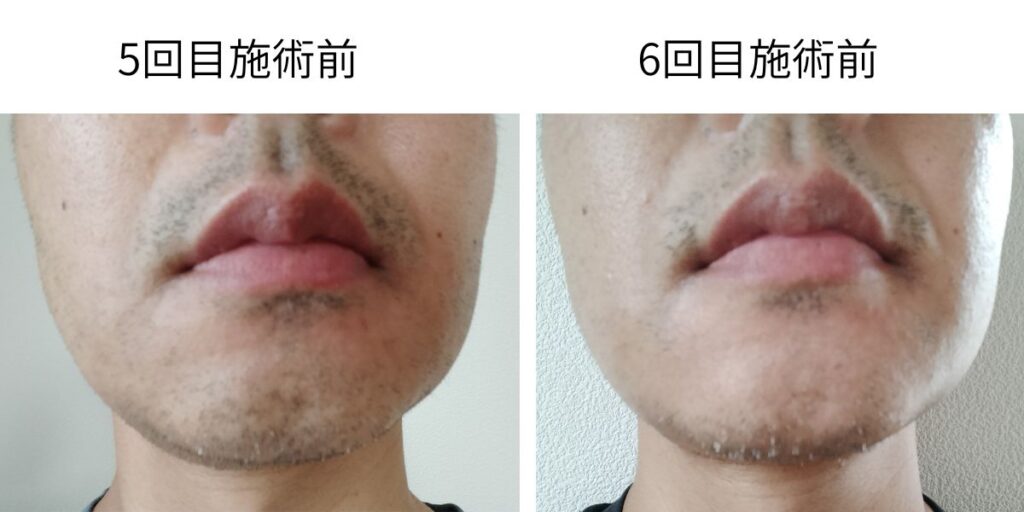 ヒゲ脱毛5回目と6回目施術前の比較写真。40代男性の実体験で、鼻下・アゴ・フェイスラインのヒゲの減り方を比較。