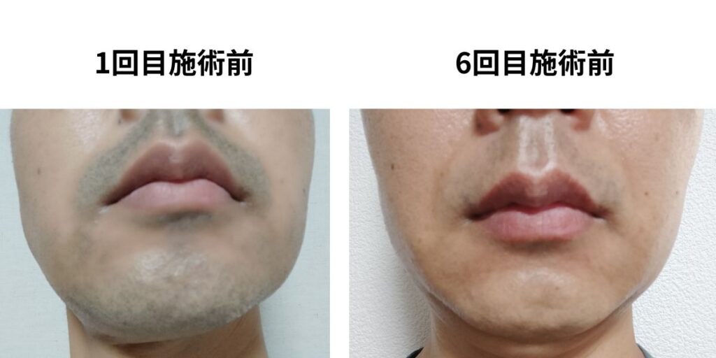 ヒゲ脱毛1回目施術前と6回目施術前の比較｜40代男性