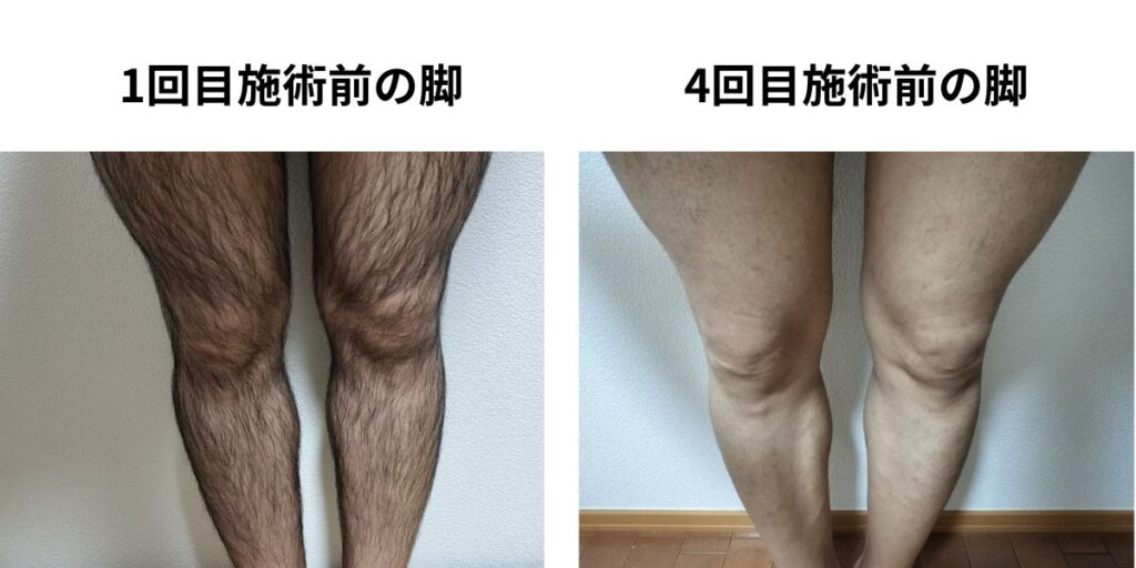 メンズ全身脱毛前と4回目施術前の脚を比較した写真。左は照射前、右は3回照射後