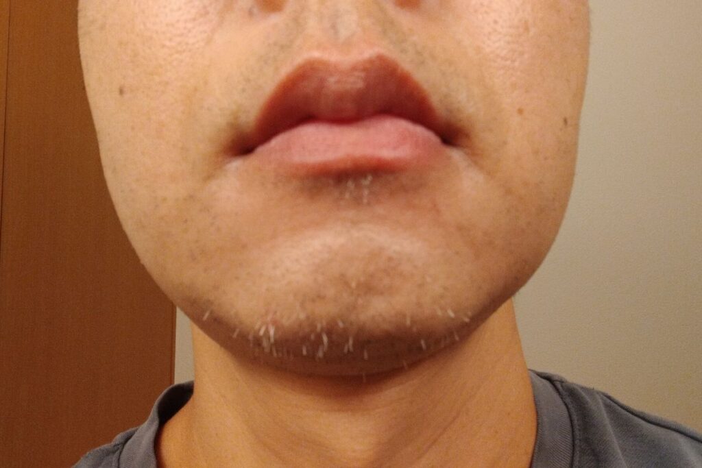 ヒゲ脱毛後に白髪が目立つ40代男性の顎