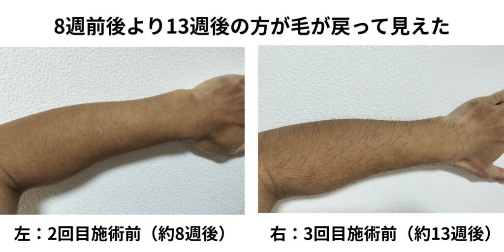 全身脱毛2回目施術前と3回目施術前の腕の毛量比較