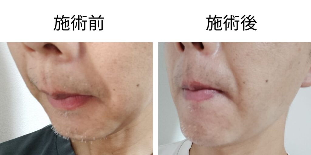 メンズリゼのニードル脱毛前後を右斜めから比較したアゴと鼻下のヒゲ白髪の画像