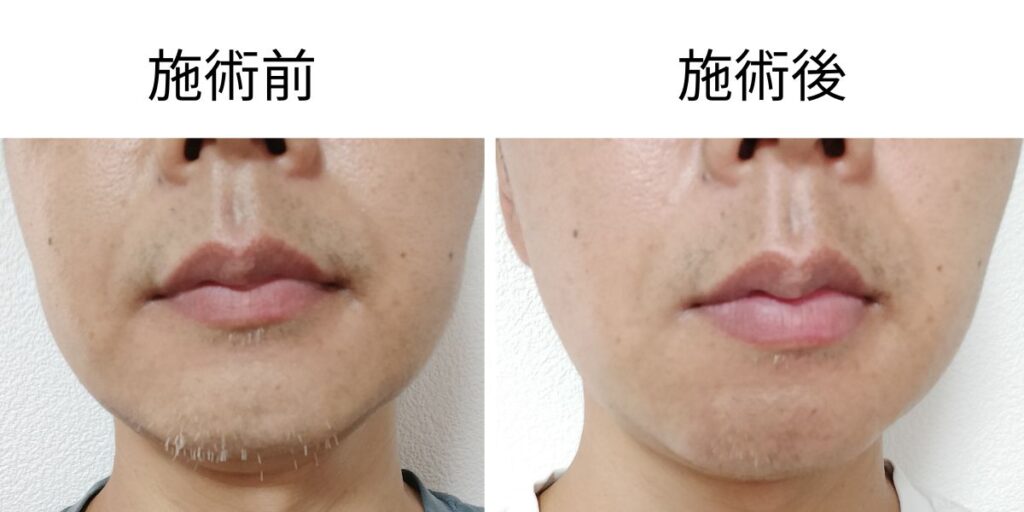 メンズリゼのニードル脱毛前後を正面から比較したヒゲ白髪の画像