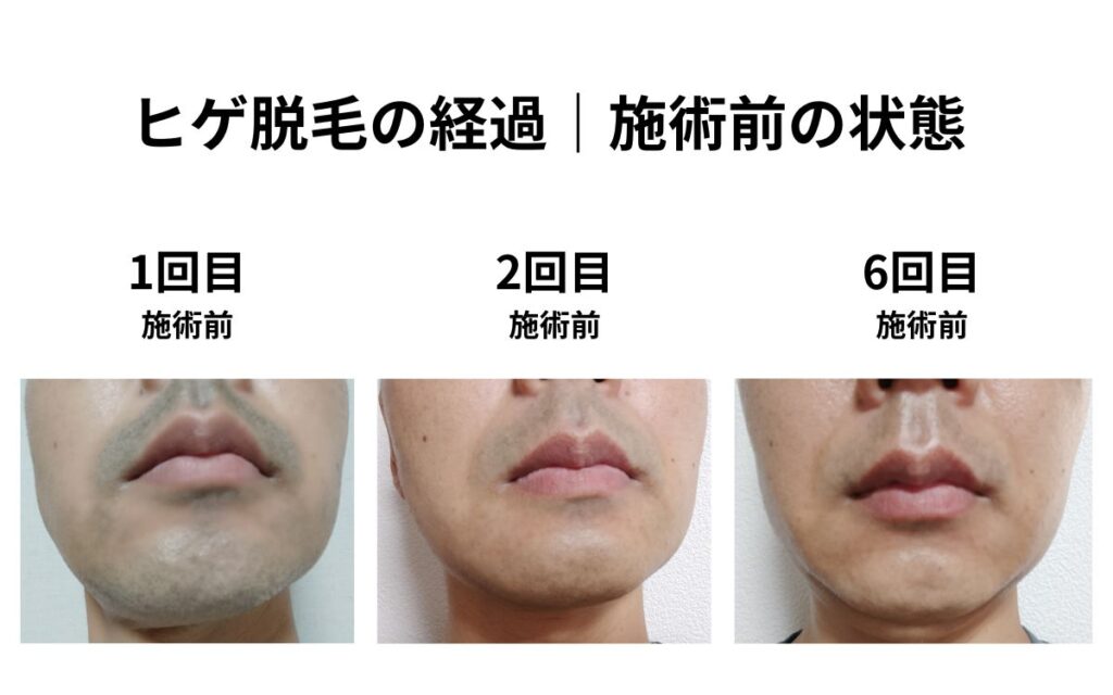 ヒゲ脱毛1回目・2回目・6回目の施術前の状態を比較した経過写真。口周りの青みや黒いヒゲの密度の変化が分かる。