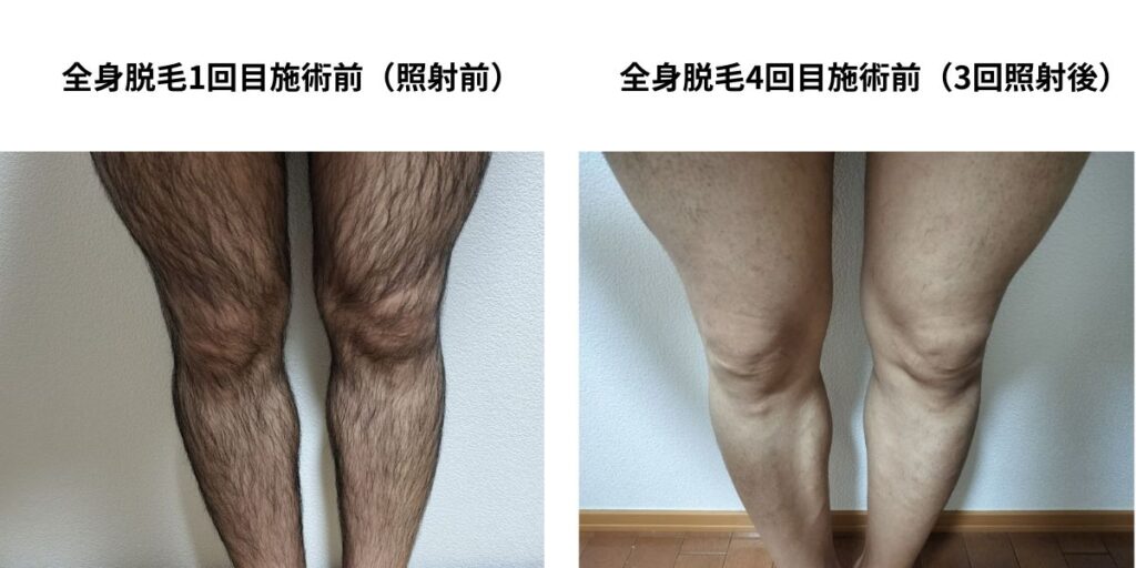 メディオスター全身脱毛1回目施術前と4回目施術前の脚の毛量比較