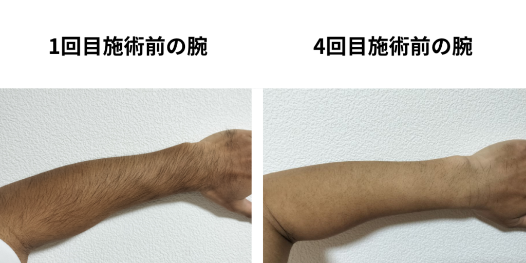 メディオスター全身脱毛1回目施術前と4回目施術前の腕の毛量比較
