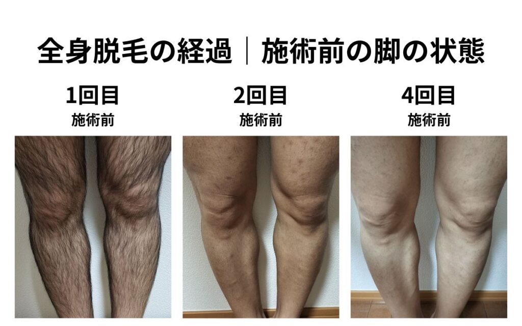 全身脱毛1回目・2回目・4回目の施術前の脚を比較した経過写真