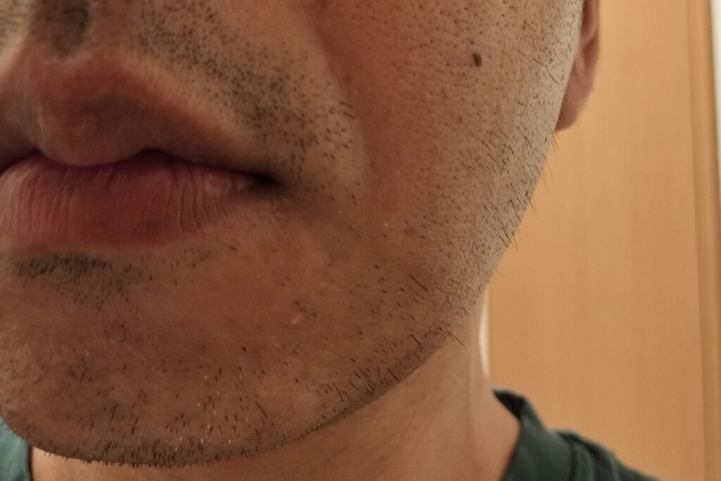 ヒゲ脱毛7回目前のサイド写真。頬とフェイスラインに細くまばらな毛が残っている