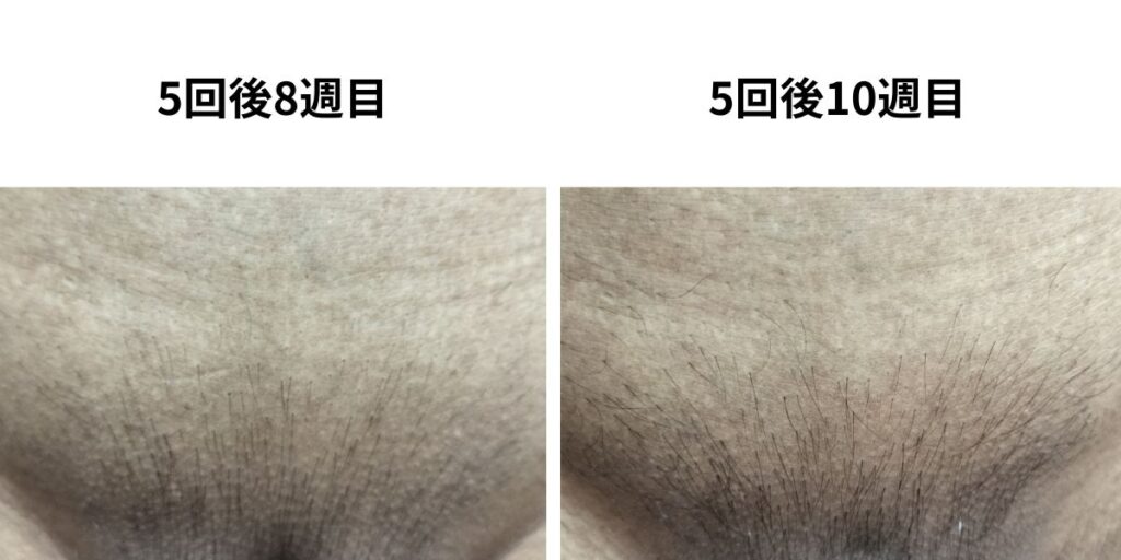 VIO脱毛5回後の8週目と10週目の生え戻りを比較した画像
