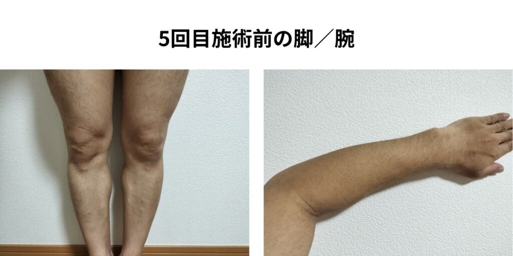 全身脱毛5回目施術前の脚と腕を並べた40代男性の写真