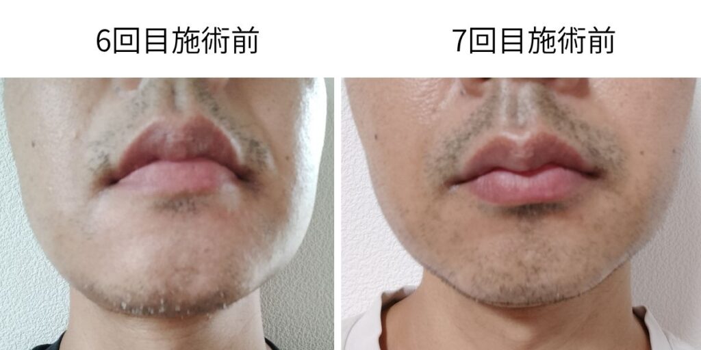 ヒゲ脱毛6回目施術前と7回目施術前の比較