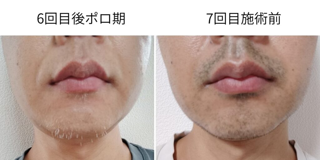 ヒゲ脱毛6回目後のポロ期と8週間後の7回目施術前の生え戻り比較