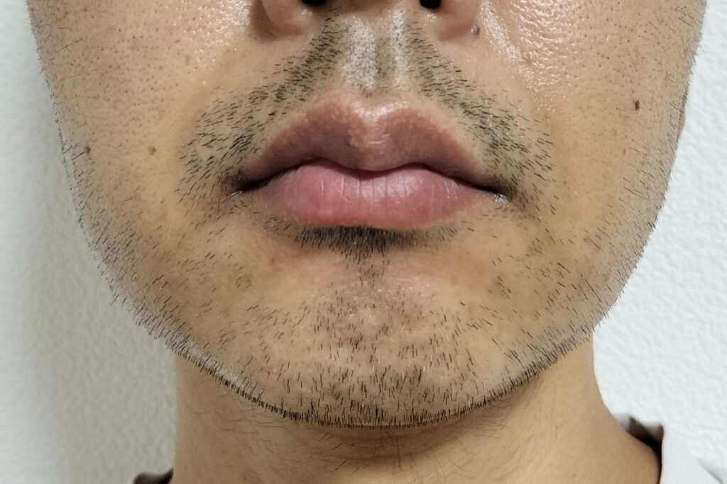 7回目施術前・6回目照射から8週間後の写真