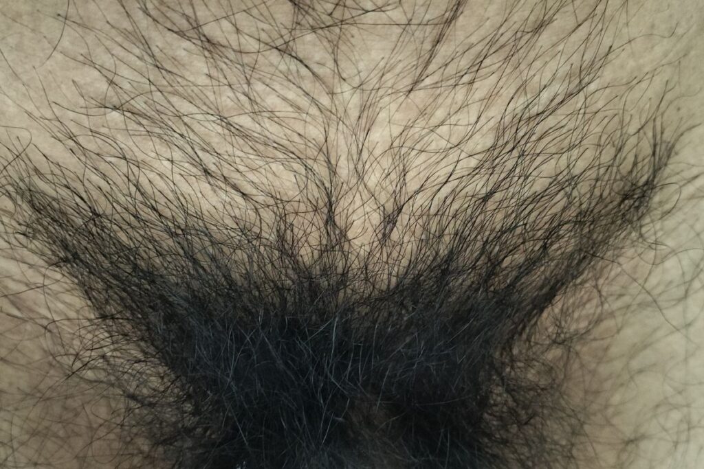 VIO脱毛を始める前の40代男性のVラインの毛量