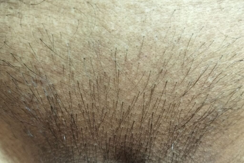 VIO脱毛5回目から10週後に残っている細い毛を接写したVライン