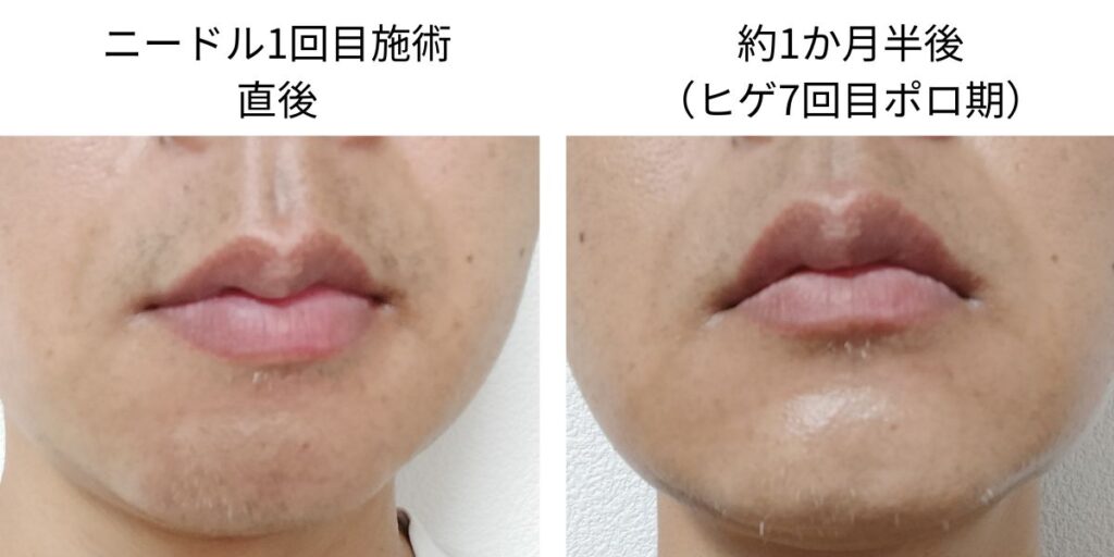 ニードル脱毛1回目直後と約1か月半後のヒゲ白髪を比較した画像