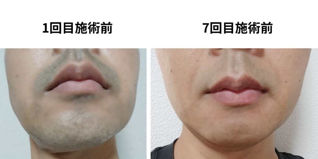 ヒゲ脱毛1回目施術前と7回目施術前の比較。全体は減ったが鼻下と口周りに毛が残っている