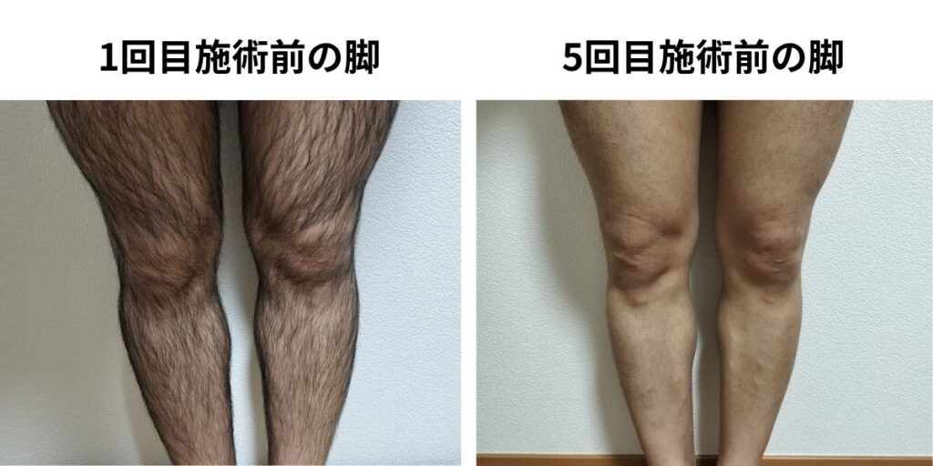 全身脱毛1回目施術前と5回目施術前の脚を比較した40代男性の写真