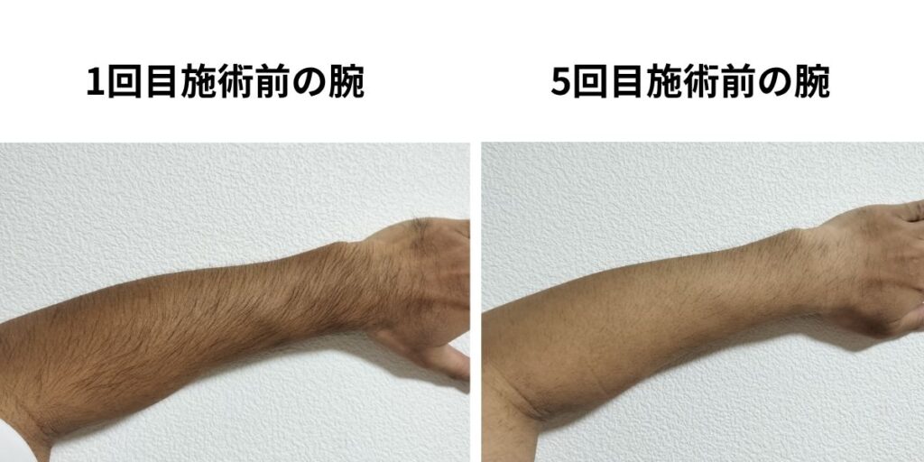 全身脱毛1回目施術前と5回目施術前の腕を比較した40代男性の写真