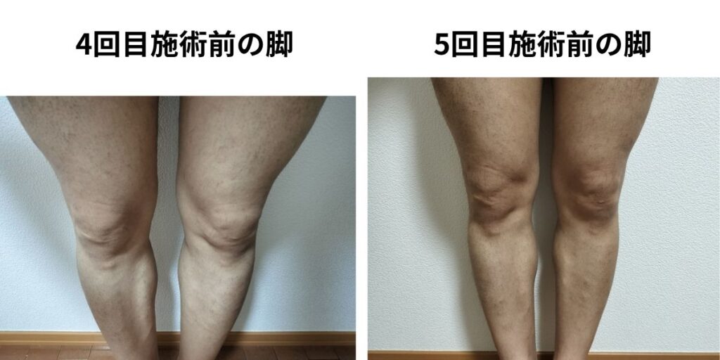 全身脱毛4回目施術前と5回目施術前の脚を比較した40代男性の写真